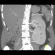 Duplex kidney: CT - Computed tomography