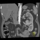 Duplex kidney: CT - Computed tomography