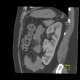 Duplex kidney: CT - Computed tomography