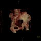 Duverney fracture, fracture of iliac wing, VRT: CT - Computed tomography