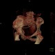 Duverney fracture, fracture of iliac wing, VRT: CT - Computed tomography