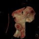 Duverney fracture, fracture of iliac wing, VRT: CT - Computed tomography