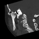 Dysplasia of head of mandible, bilateral: CT - Computed tomography