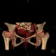 Dysplasia of femoral head: CT - Computed tomography