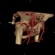 Dysplasia of femoral head: CT - Computed tomography