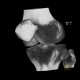 Dysplasia of patella, patellar dysplasia: CT - Computed tomography