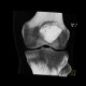 Dysplasia of patella, patellar dysplasia: CT - Computed tomography