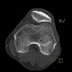 Dysplasia of patella, patellar dysplasia: CT - Computed tomography