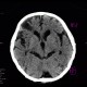 Dandy Walker variant, mega cisterna magna: CT - Computed tomography