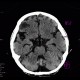 Dandy Walker variant, mega cisterna magna: CT - Computed tomography