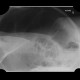 Megacolon, decompensated: X-ray - Plain radiograph