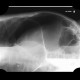 Megacolon, decompensated: X-ray - Plain radiograph