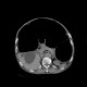 Megacolon, decompensated: CT - Computed tomography