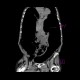 Megacolon, decompensated: CT - Computed tomography