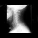 Degenerative changes of the cervical spine: X-ray - Plain radiograph