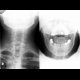 Degenerative changes of the cervical spine: X-ray - Plain radiograph