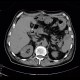 Delayed excretion of contrast from kidney, day four: CT - Computed tomography
