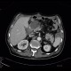 Delayed excretion of contrast from kidney, day one: CT - Computed tomography