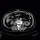 Delayed excretion of contrast from kidney, day four: CT - Computed tomography