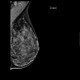 Mammography, dense type, normal finding: MMG - Mammography