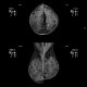 Mammography, dense type, normal finding: MMG - Mammography