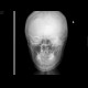 Depressive fracture of skull: X-ray - Plain radiograph