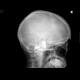 Depressive fracture of skull: X-ray - Plain radiograph