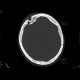 Depressive fracture of skull: CT - Computed tomography