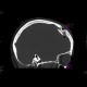 Depressive fracture of skull: CT - Computed tomography