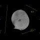 Depressive fracture of skull: CT - Computed tomography