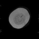 Depressive fracture of skull: CT - Computed tomography