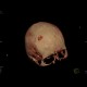 Depressive fracture of skull: CT - Computed tomography