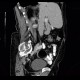Dermoid of ovary: CT - Computed tomography