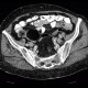 Dermoid of ovary: CT - Computed tomography