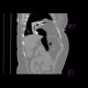 Diaphragmatic hernia, Morgagni hernia: CT - Computed tomography