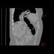 Diaphragmatic hernia, Morgagni hernia: CT - Computed tomography