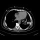 Diaphragmatic hernia, Morgagni hernia: CT - Computed tomography