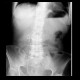 Distention of stomach: X-ray - Plain radiograph