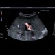 Obstruction of biliary stent, dilated intrahepatic biliary ducts: US - Ultrasound