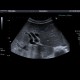 Obstruction of biliary stent, dilated intrahepatic biliary ducts: US - Ultrasound