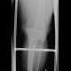 Dislocation of knee joint: X-ray - Plain radiograph