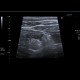 Acute diverticulitis, sigmoid colon: US - Ultrasound