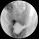 Diverticular disease of the sigmoid colon: RF - Fluoroscopy