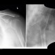 Posterior dislocation of glenohumeral joint: X-ray - Plain radiograph