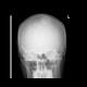 Hair clip, mimic of meningioma: X-ray - Plain radiograph