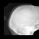 Hair clip, mimic of meningioma: X-ray - Plain radiograph