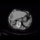 Abscess, perihepatic abscess, drainage, pig-tail: CT - Computed tomography