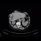 Abscess, perihepatic abscess, drainage, pig-tail: CT - Computed tomography