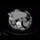 Abscess, perihepatic abscess, drainage, pig-tail: CT - Computed tomography