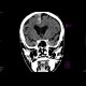 Subarachonid hemorrhage, minute: CT - Computed tomography